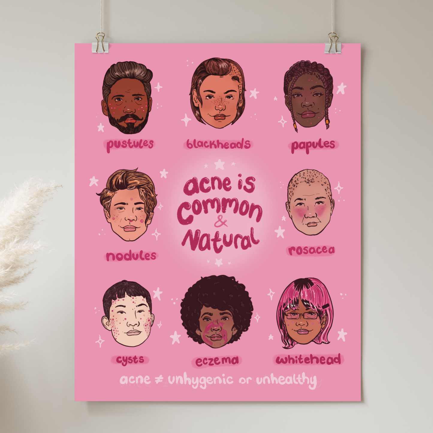 Acne is Common & Natural - Print